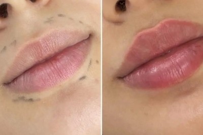 Juvederm Lip Fillers Guide by the Best Plastic Surgeons in Dubai