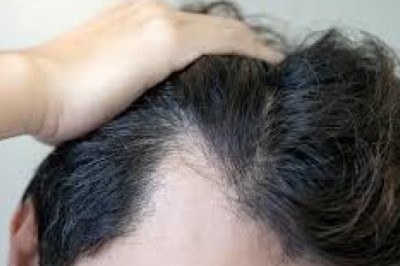 Stem Cell Therapy for Hair in Dubai: Regenerative Growth Treatment