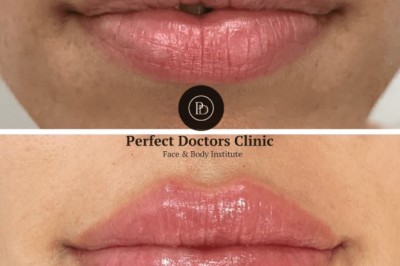 Can You Return to Work After a Juvederm Treatment in Dubai?