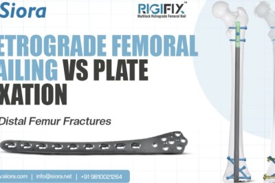 Retrograde Femoral Nailing vs Plate Fixation for Distal Femur Fractures