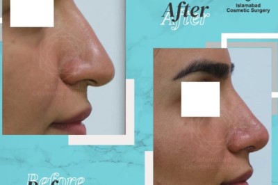 Top Benefits of Rhinoplasty in Islamabad for Natural Results