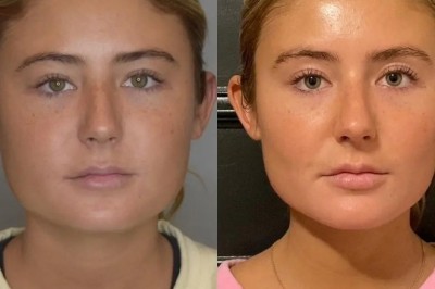How Buccal fat removal in Dubai Supports a Sculpted Appearance