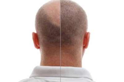 Hair Transplant in Riyadh with Advanced Follicle Mapping