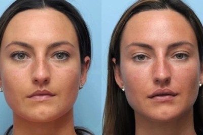Thread Lift Treatments in Dubai Designed for Professional Non Surgical Beauty Enhancement