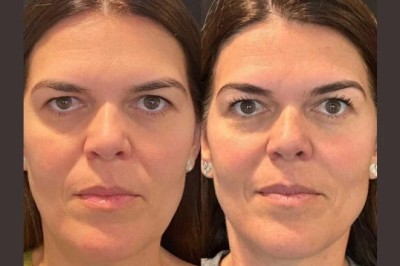 Best Doctors in Dubai: Thread Lift Procedures for Youthful Glowing Skin