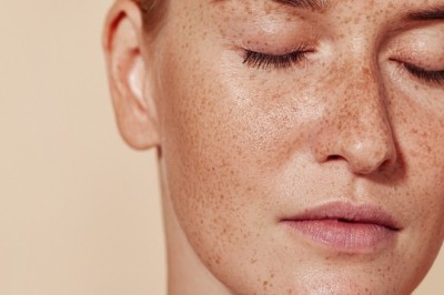 Pigmentation Treatment in Dubai: Understanding Treatment Timelines