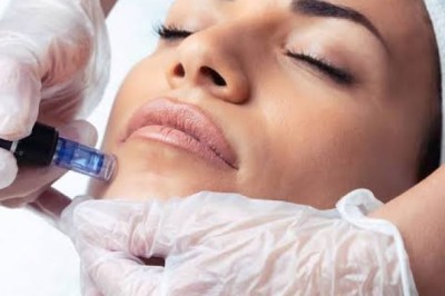 Laser For Rosacea In London: Modern Treatments for Lasting Skin Comfort