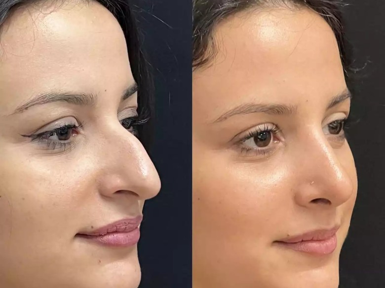 Septoplasty in Dubai